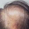 产后大量脱发的病因有什么