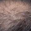 导致病理性脱发的病因有什么