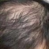 常见脱发类型有什么