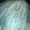 常见脱发的病因有什么_脱发