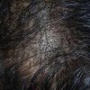 病理性脱发我们应该明了其病症谨慎对待