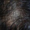 斑秃脱发如何治疗