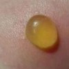 疥疮最初症状