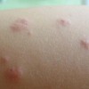脂溢性皮炎是怎样预防的
