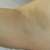 比基尼部位能够挑选冰点脱毛吗哪里脱毛好