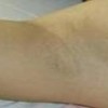 激光脱毛的常见疑问