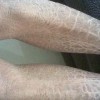 哪里治疗鱼鳞病