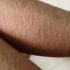 青岛百姓皮肤病医院告诉你如何治疗鱼鳞病