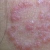 患者生活防护股癣六大法