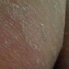 春季做好股癣的日常预防事项