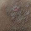 股癣症状你明白多少