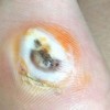 鸡眼要怎么清除