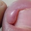 为您认真介绍一点甲沟炎的预防措施