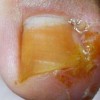 生活中预防甲沟炎的措施是啥
