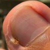 甲沟炎复发怎样的预防