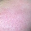 过敏性湿疹患者该怎样保护皮肤
