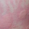 秋季到来怎样的防止肌肤过敏