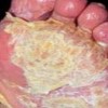 关节型银屑病的护理规定是啥