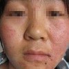 过敏性皮炎治疗花费