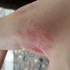 青岛怎样能治疗皮炎