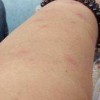 颈部过敏性皮炎怎么办