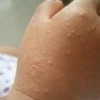 过敏性皮炎该咋办有用的开始治疗