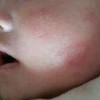 颈部接触性皮炎怎么办