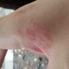 颈部神经性皮炎怎么办