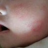 青岛怎样治理皮炎
