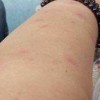 面部显示皮炎如何办好