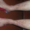 频繁使用化妆品导致的皮炎如何治疗好