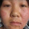 过敏性皮炎的治疗方法有哪些