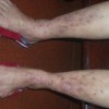 过敏性皮炎的医治的方法都包含什么呢