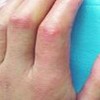 充满性硬皮病更新疗法