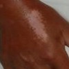 硬皮病病对患者皮肤伤害引荐