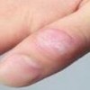 系统性硬皮病患者的饮食要留意啥