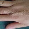 新生儿硬皮病的症状有哪些