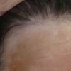 白癜风表现有啥症状