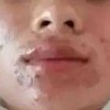 成人痤疮怎样的预防有效