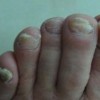 灰指甲的5种症状