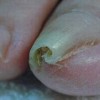 从图片上识别灰指甲的典型症状