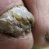 大疱性表皮松解症致使灰指甲