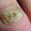 得了灰指甲的症状有哪些