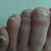 不一样类型的灰指甲症状