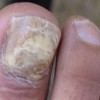 大家明白不？灰指甲表现有啥