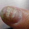 灰指甲的的伤害有什么