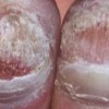 灰指甲的发病症状和常见体现是啥