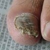 得灰指甲特点有什么