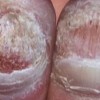 灰指甲的表现首要体现在哪里呢