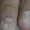 灰指甲的多见症状有哪些